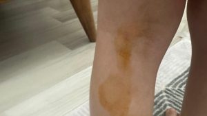 Şanlıurfa’da 3 yaşındaki çocuk köpeklerin saldırısına uğradı